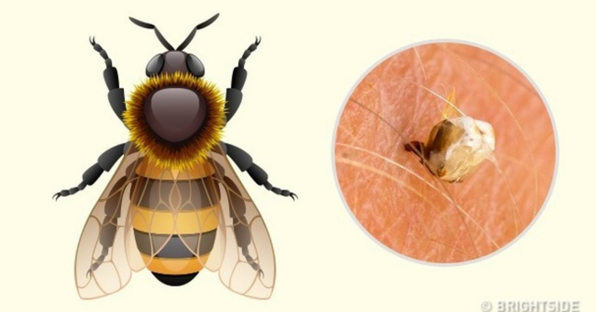 Cách xử lý nhanh khi bị côn trùng cắn sưng to và ngứa